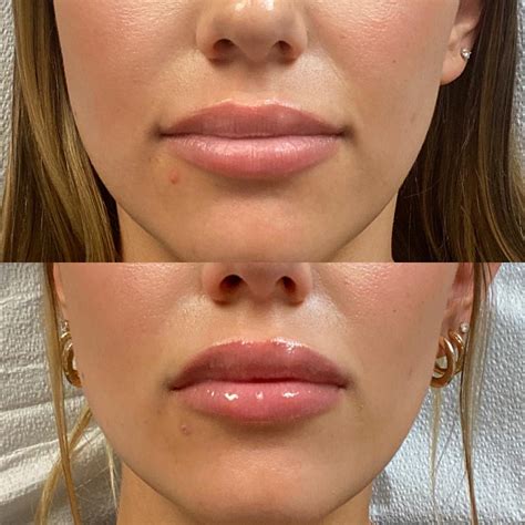 versa filler reviews